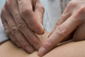 Sevrage tabagique : l'acupuncture Sevrage tabagique : l'acupuncture
