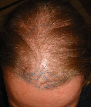 Alopécie féminine Alopécie féminine