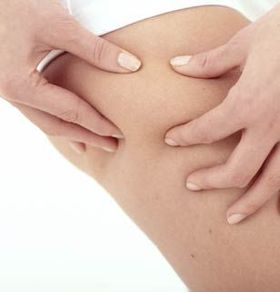 liposuccion, lipolyse et cellulite