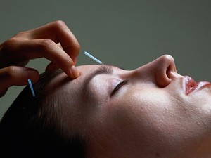 acupuncture thérapie alternative