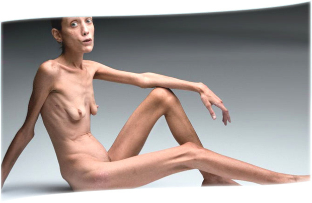 Anorexie, un régime sans fin : Anorexie, le dégoût de son corps Anorexie, un régime sans fin : Anorexie, le dégoût de son corps